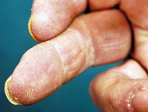 Researchers try to regrow fingers and even limbs  