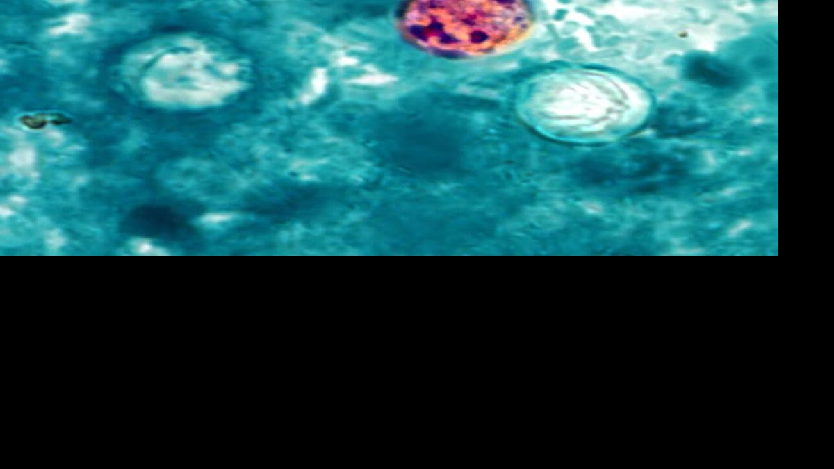 ‘Explosive diarrhea’ infections rise to 5 cases in Pima County