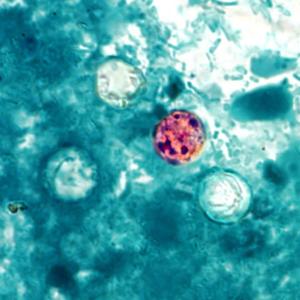 ‘Explosive diarrhea’ infections rise to 5 cases in Pima County