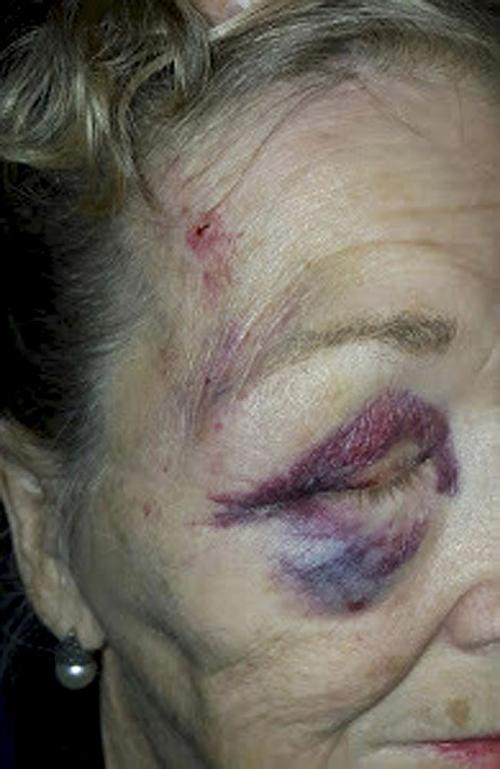 84-year-old woman claims excessive force in lawsuit against Mesa police