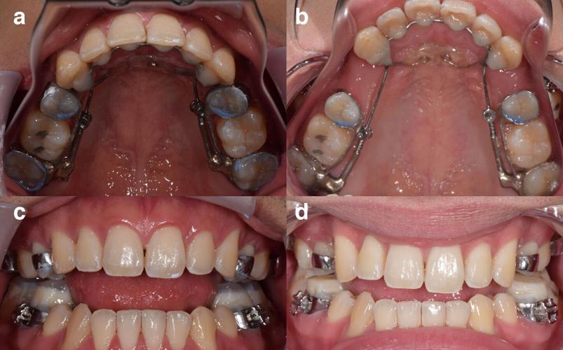 AGGA dental device