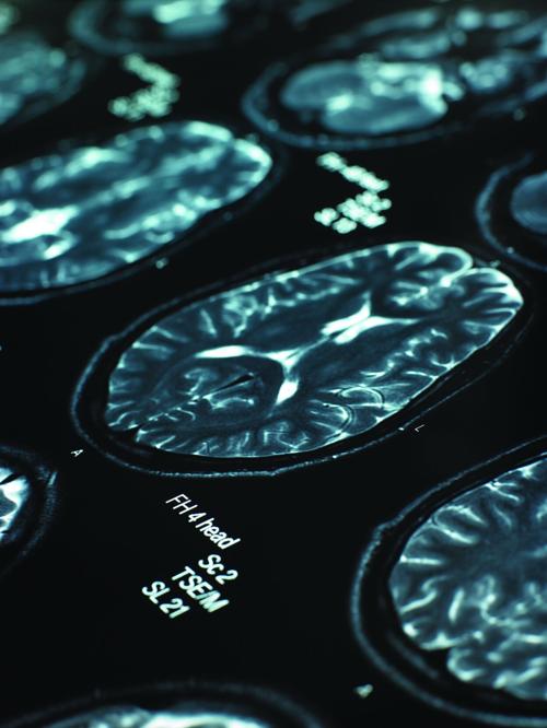 What to know about stroke