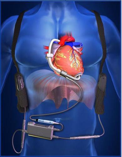 ReliantHeart HeartAssist