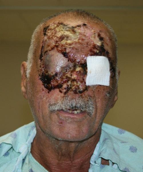 Ronald Poppo, face-chewing victim (graphic content)