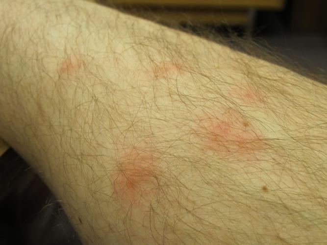 Bed bugs up close and personal