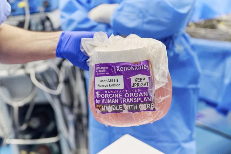 Pig kidney transplant recipient doing well after operation