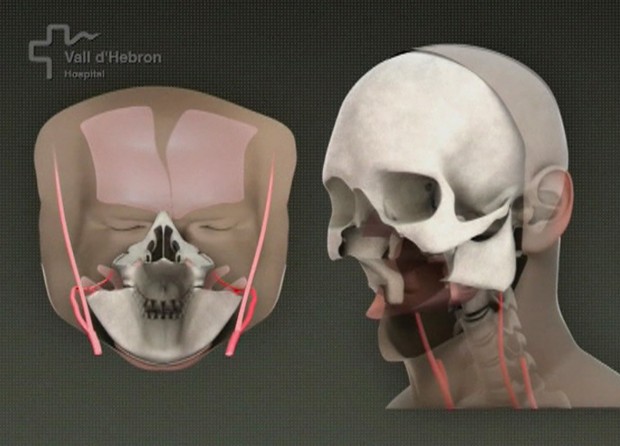 Surgical team in Spain does full-face transplant   