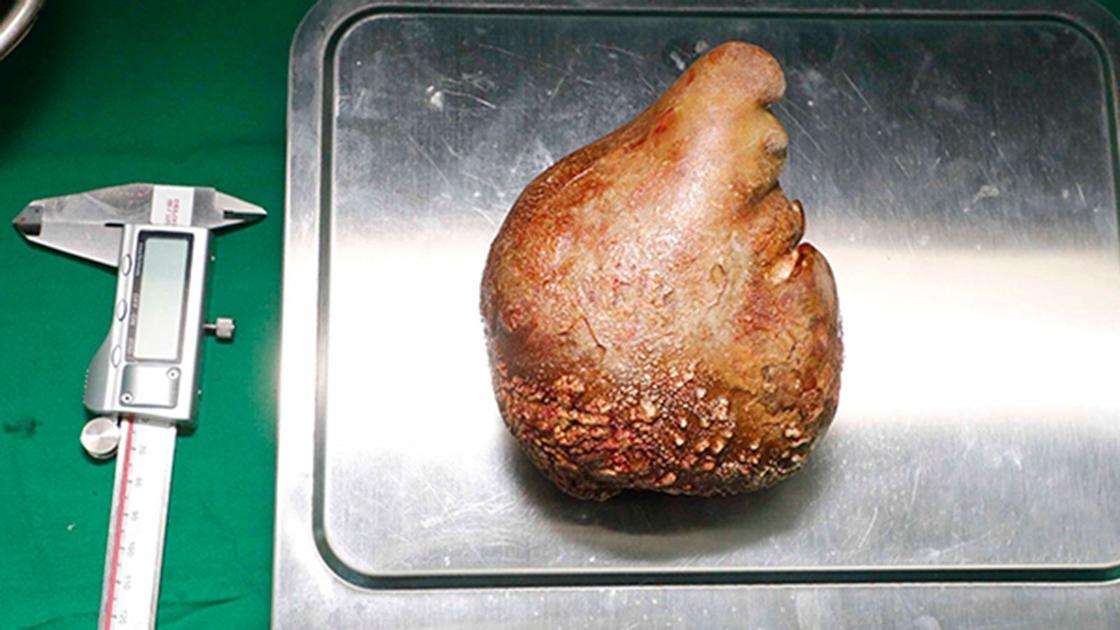 The world’s largest kidney stone has been removed — and it’s the size of a grapefruit