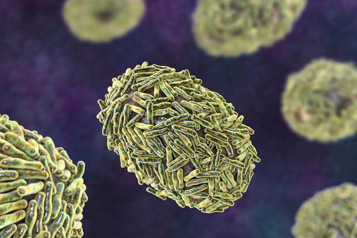 What is monkeypox, and how can you stay safe as it spreads?