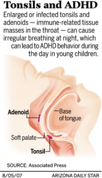 Tonsil Removal May Cure Adhd Behavior In Kids Health And