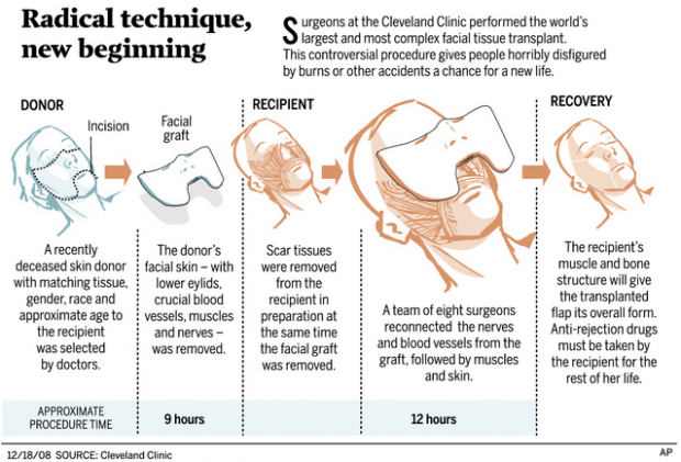 Face transplant recipient 'happy' now  