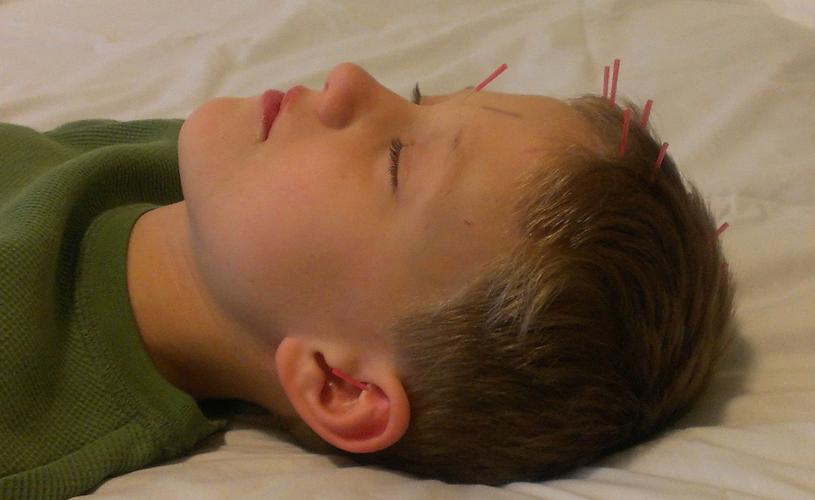 Scalp Acupuncture For Focus and Stress Relief