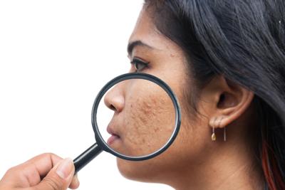 premium-health-acne-20210407