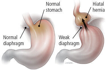 What is a hiatal hernia?