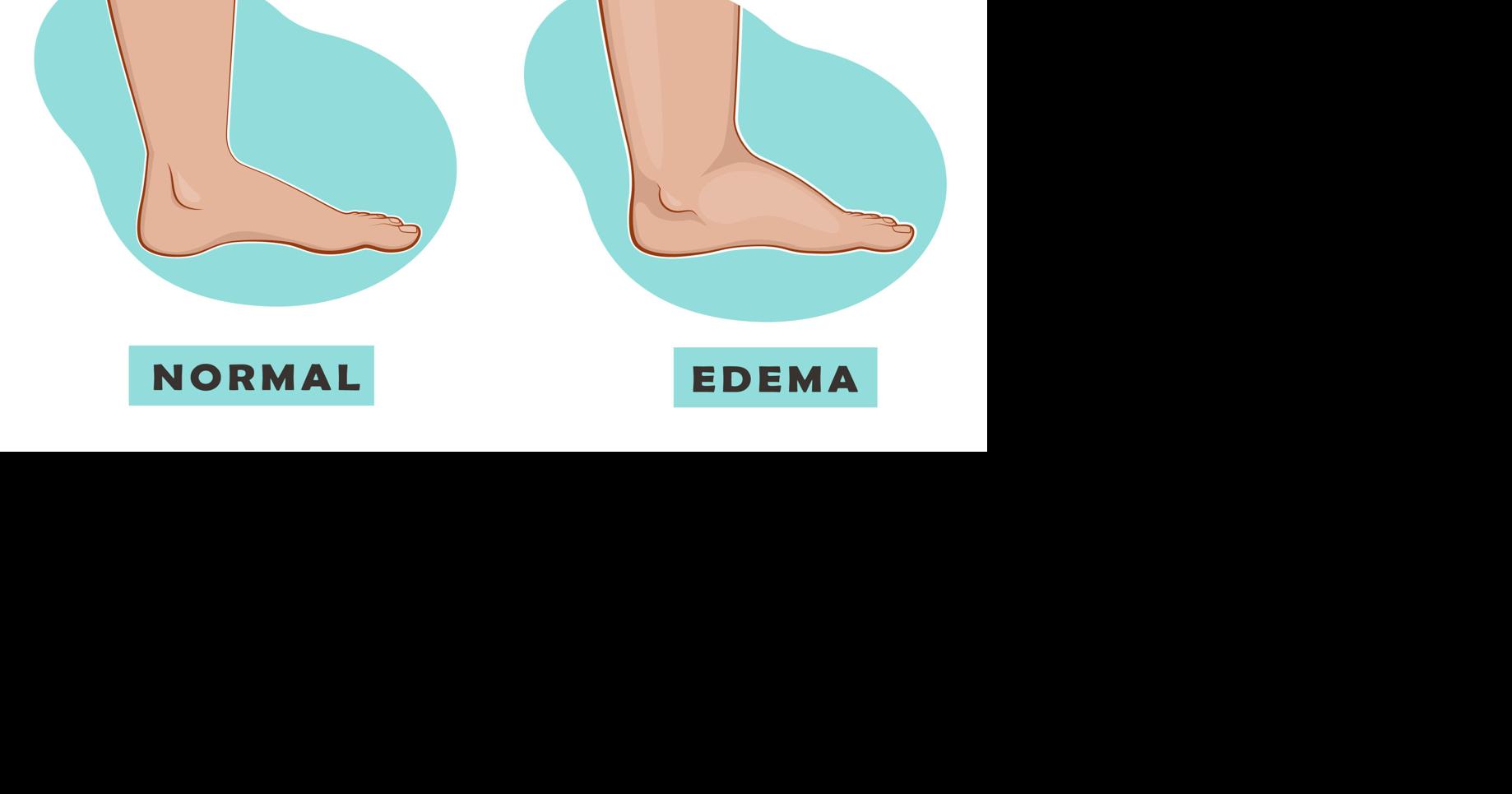 Ask the Doctors: Temporary edema is often harmless
