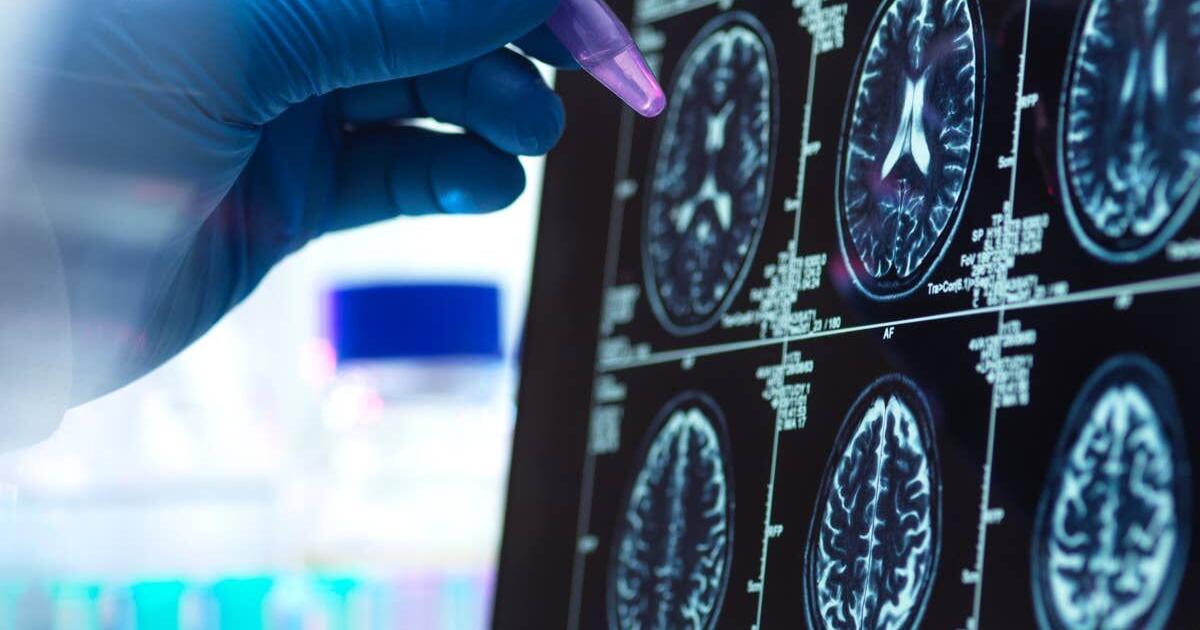 3-groundbreaking-alzheimers-treatments-on-the-horizon