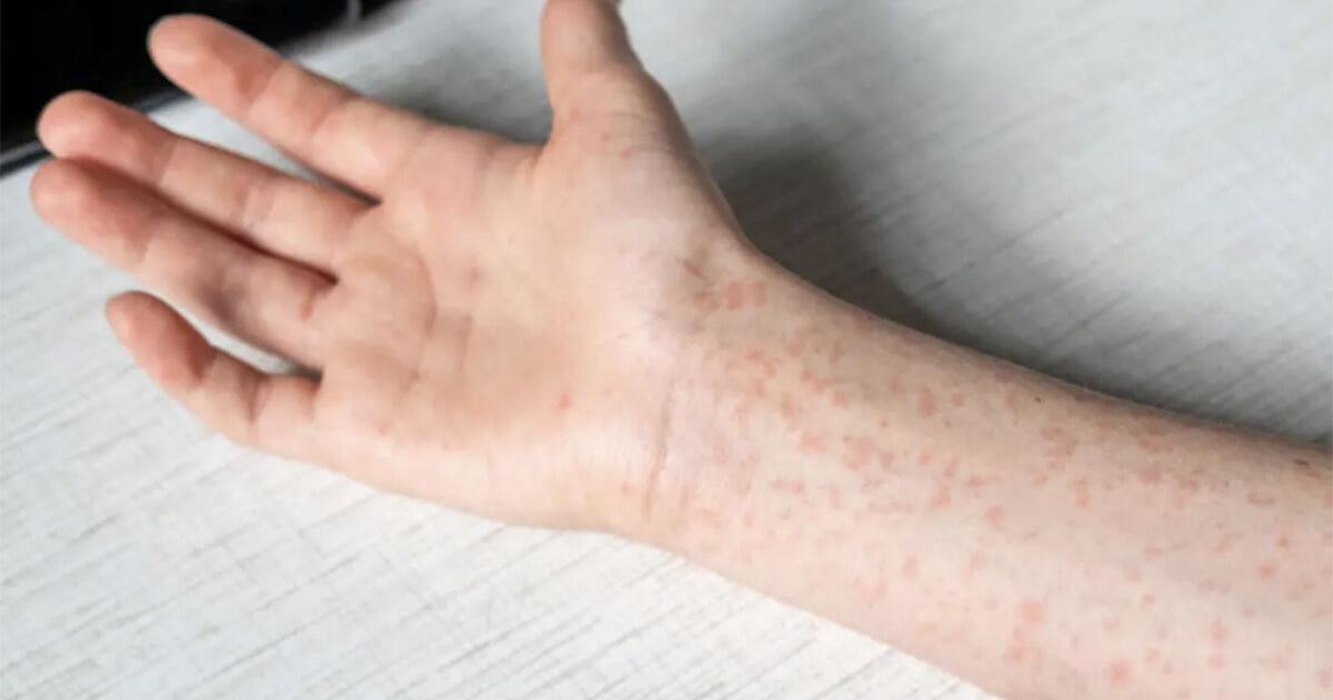 Child at Copley Hospital tests positive for measles | Local News ...