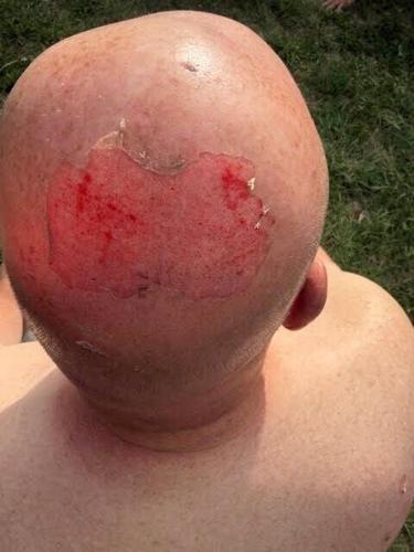 camper fire - p2 - head burns