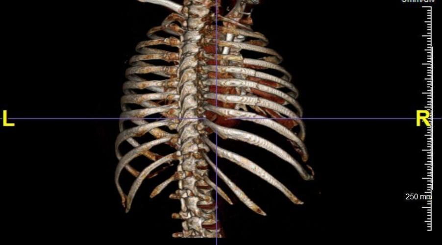 Jim Berry ribs, before surgery