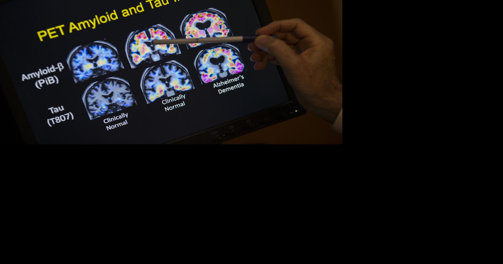 Clinic seeking participants for study of early Alzheimer’s disease