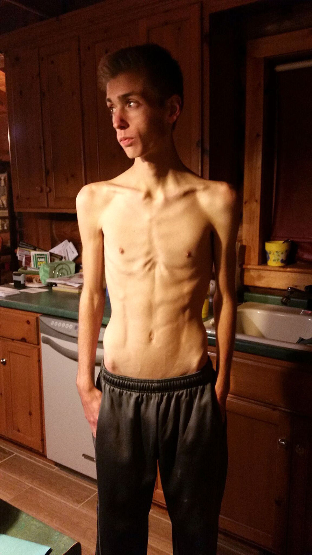 Teen Winning Anorexia Battle But Fears Remain Local News 