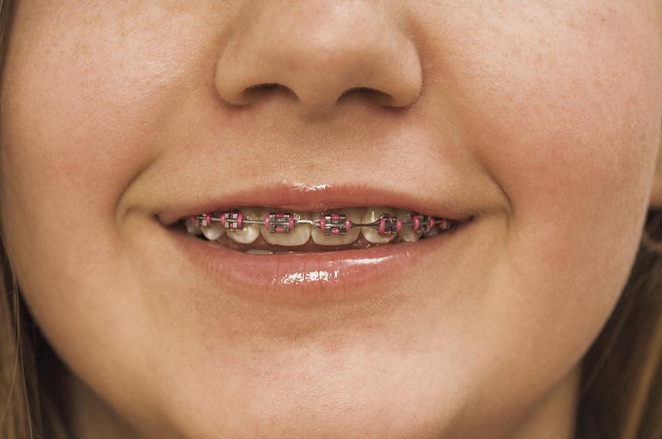Tips for making braces more comfortable Health
