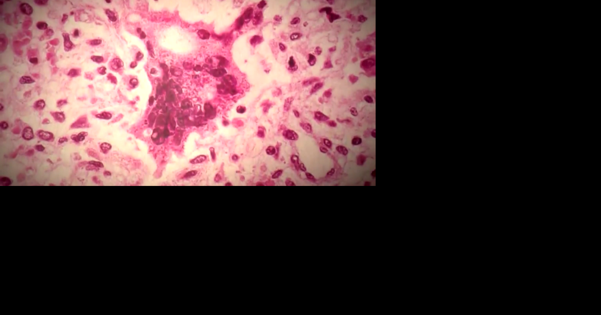 Measles Outbreak in Southwest Florida Sparks Debate Over Vaccine Opt-Out Bill