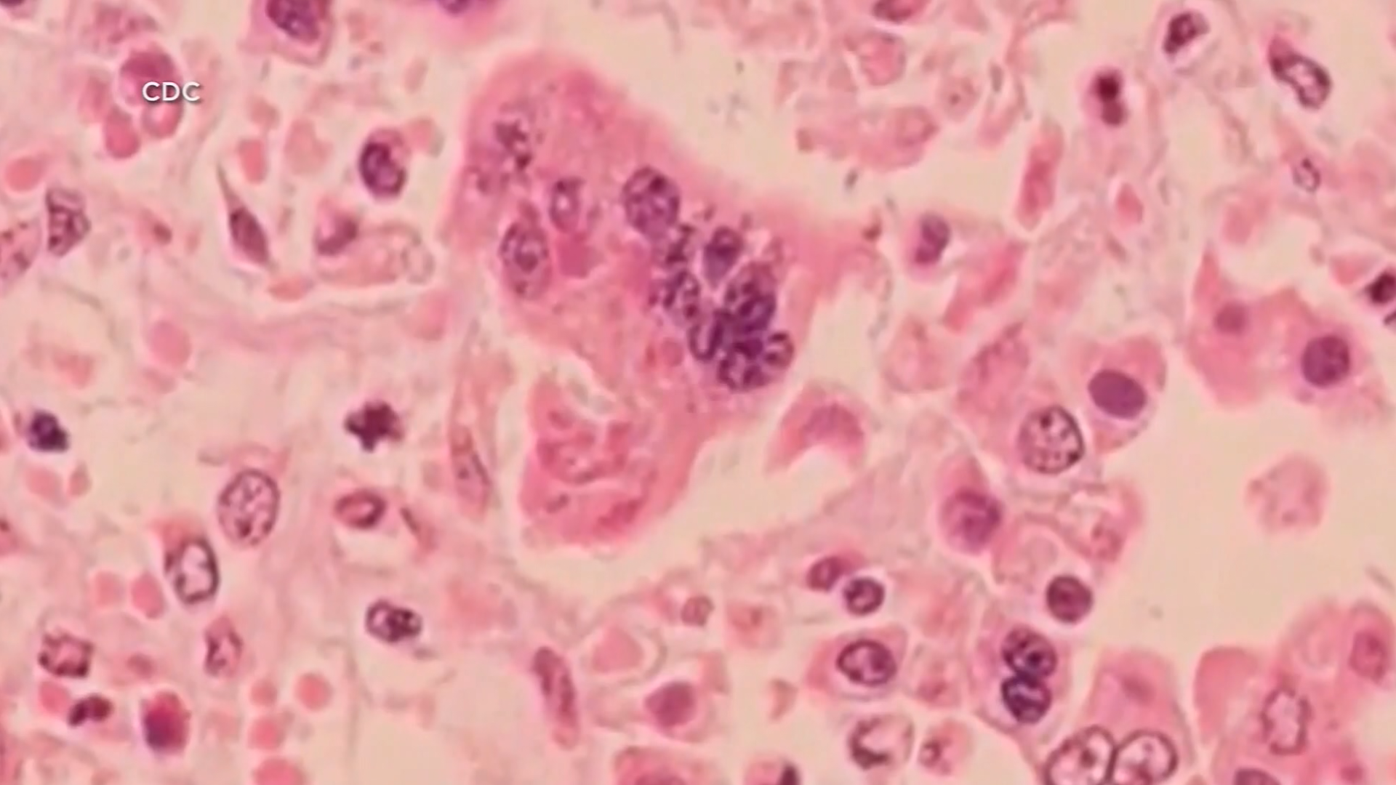 57 Cases of Measles Confirmed at Ave Maria University, 7 Currently Contagious