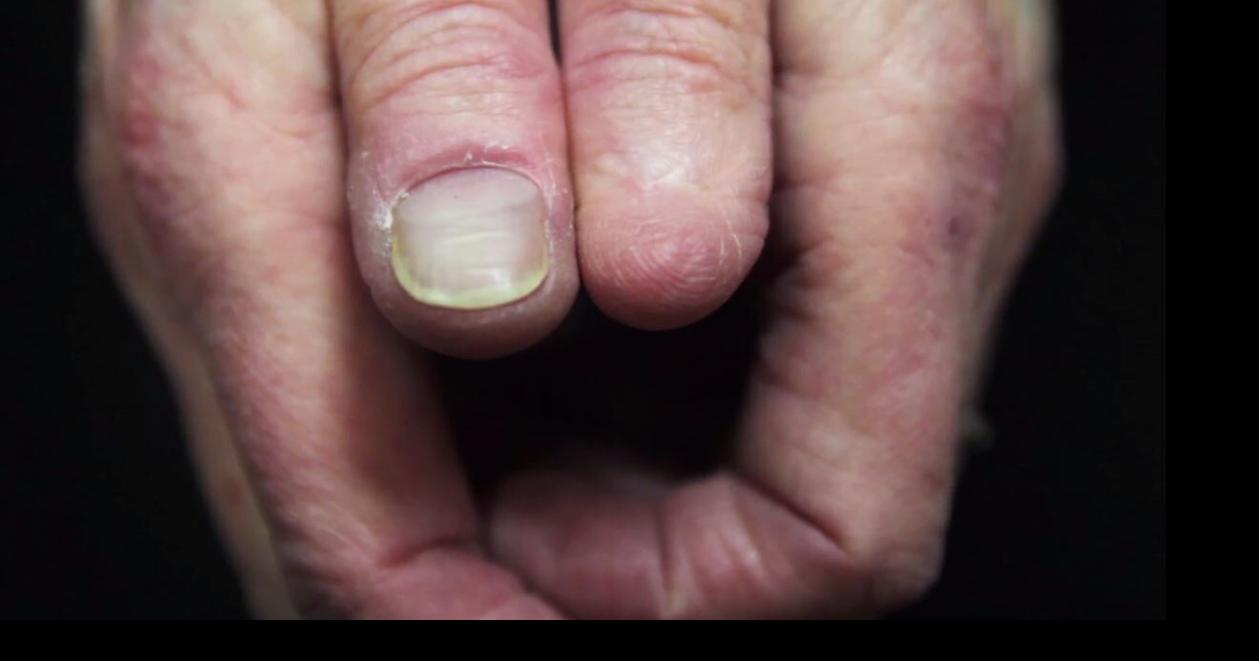 Doctors warn about skin cancer under fingernails News