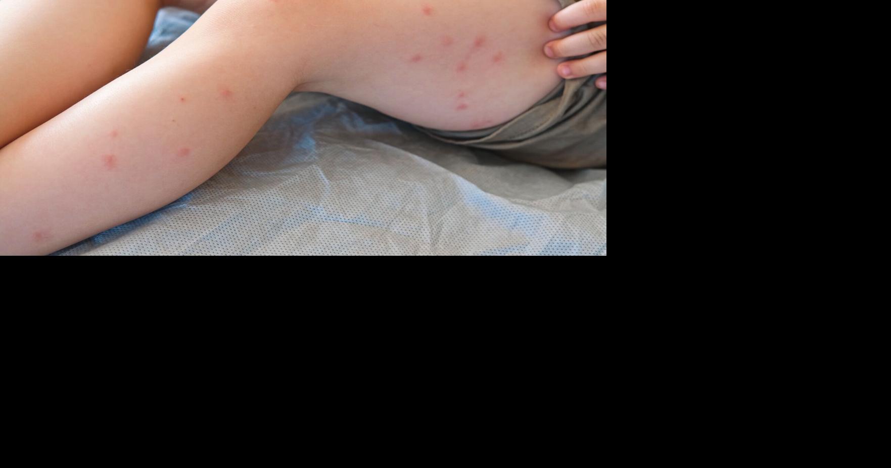 Measles exposure sites identified in Morden and Winnipeg