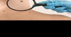 Healthful Hints: Electrodessication and curettage for basal, squamous cell skin cancers - Vimarsana News