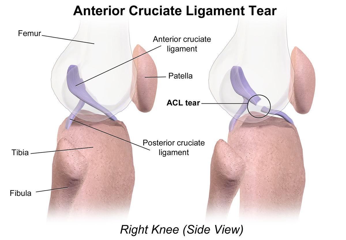 Athletics Programs Fight Acl Injuries Regional News