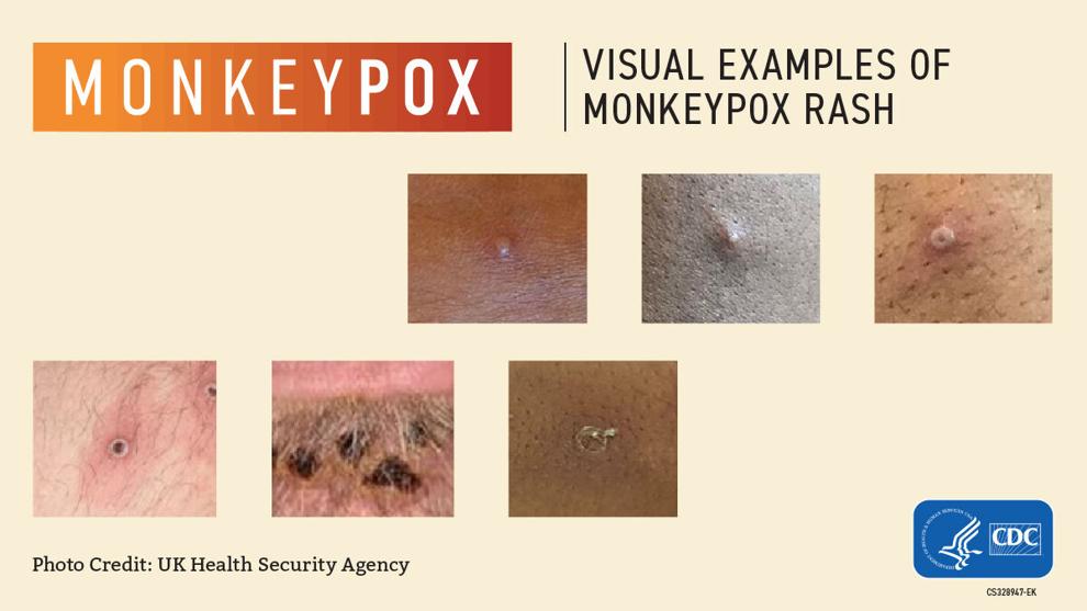 First probable case of monkeypox in West Virginia WV News
