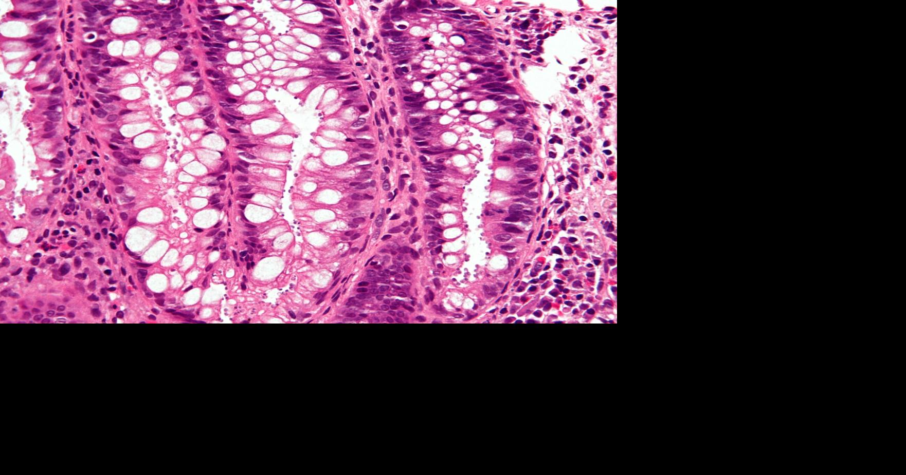 West Virginia declares statewide cyclosporiasis outbreak: Symptoms, prevention and what to know