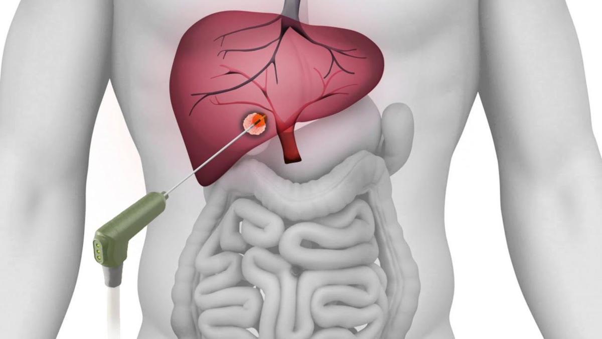 CAMC in Charleston, WV, offers microwave ablation for liver cancer WV