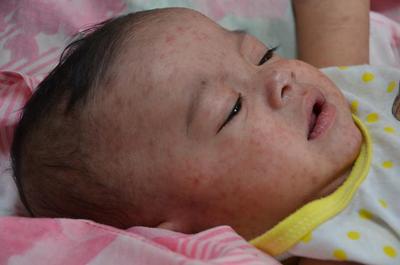Infant measles.
