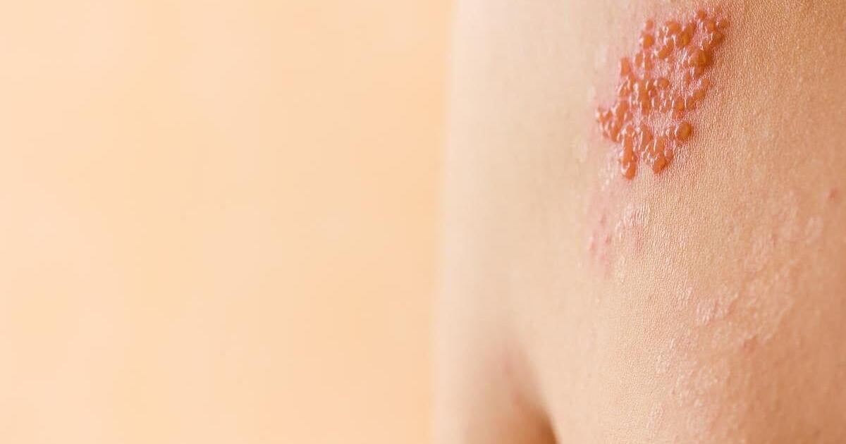 La vacuna contra el herpes zóster protege contra las enfermedades cardíacas, la demencia y la muerte – WV News