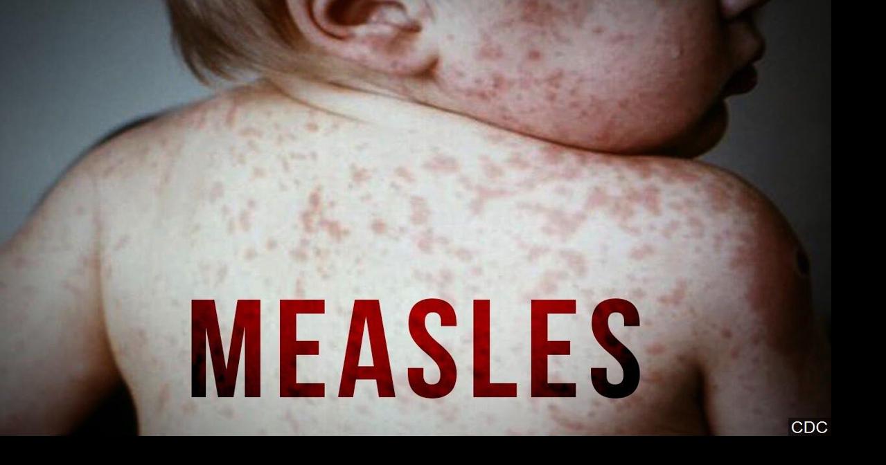 Wyoming's first 2026 confirmed measles case reported in Fremont County