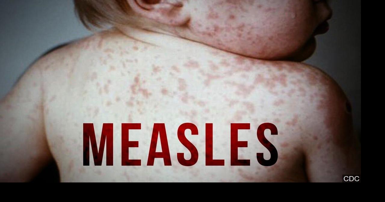 Potential measles exposure at Denver International Airport