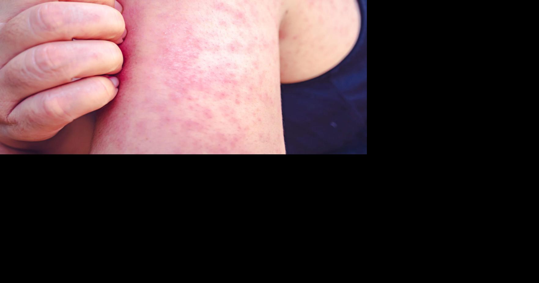 Grant Co. Man Visits Public Places While Infectious With Measles