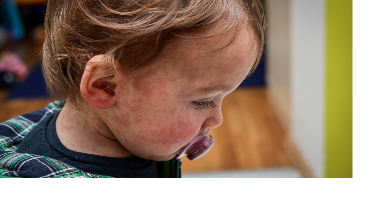 Measles detected in Anchorage wastewater samples, officials say