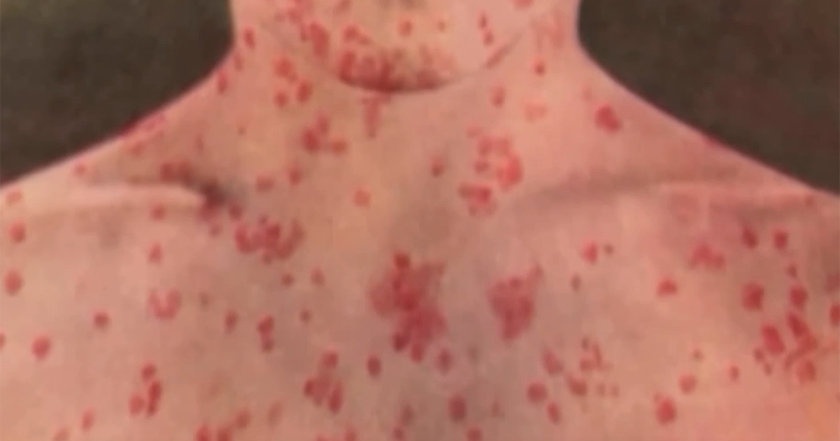 First measles case in Wyoming since 2010 reported in Natrona County